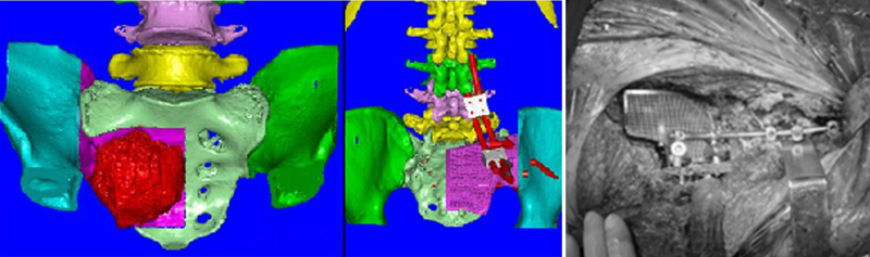 Протезирование крестца с применением SLM-печати